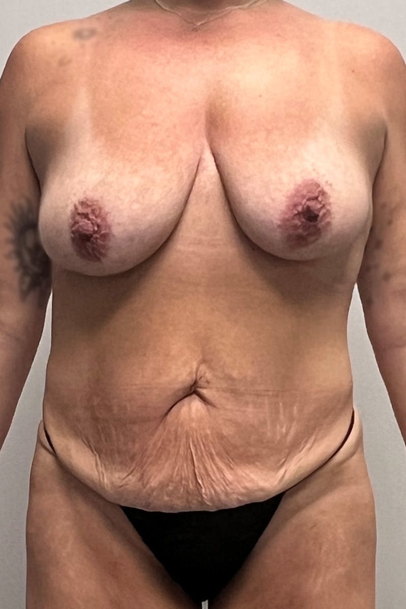 Mommy Makeover Before & After Gallery - Patient 181702 - Image 1