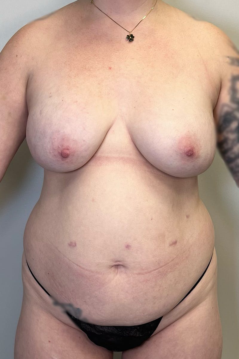 Tummy Tuck Before & After Gallery - Patient 149635 - Image 1