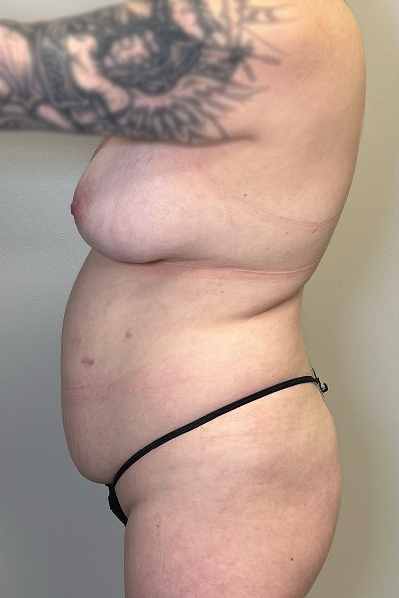 HD Liposuction 360  Before & After Gallery - Patient 334280 - Image 5