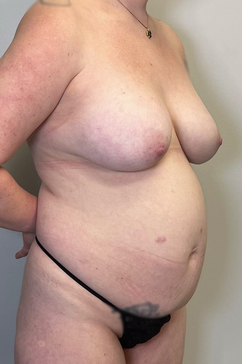 Tummy Tuck Before & After Gallery - Patient 122352 - Image 7