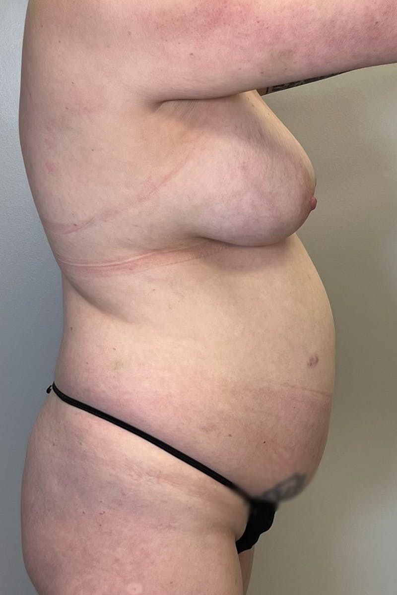 Tummy Tuck Before & After Gallery - Patient 149635 - Image 9