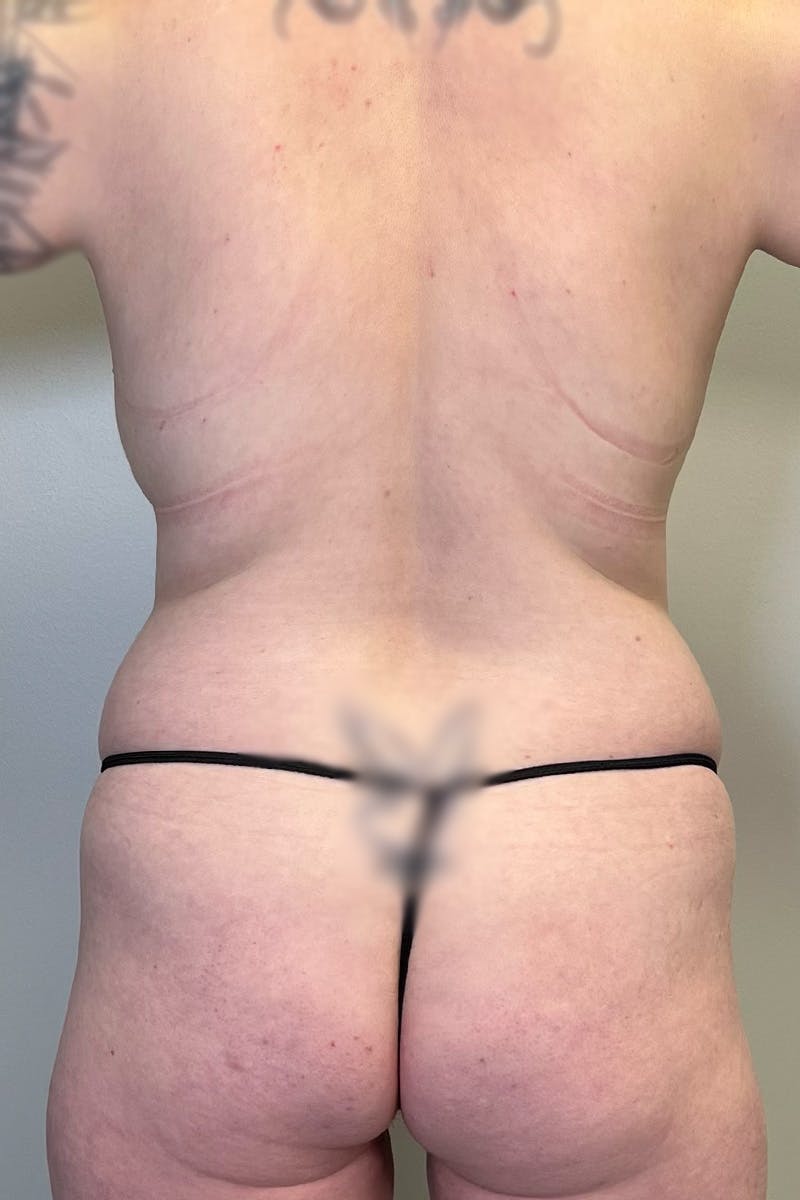 HD Liposuction 360  Before & After Gallery - Patient 334280 - Image 11