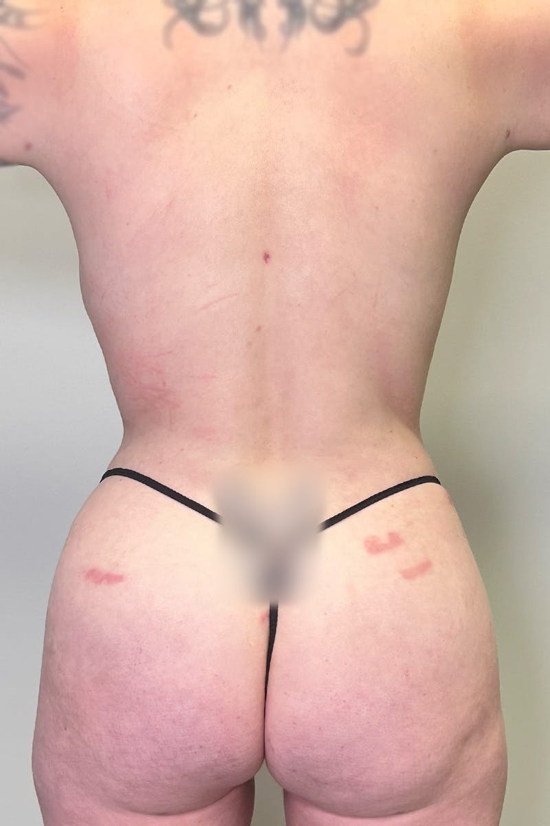 HD Liposuction 360  Before & After Gallery - Patient 334280 - Image 12