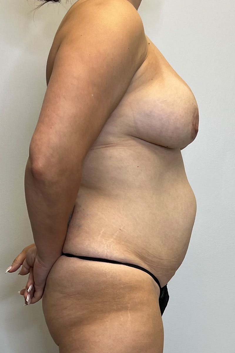 Tummy Tuck Before & After Gallery - Patient 143665 - Image 5
