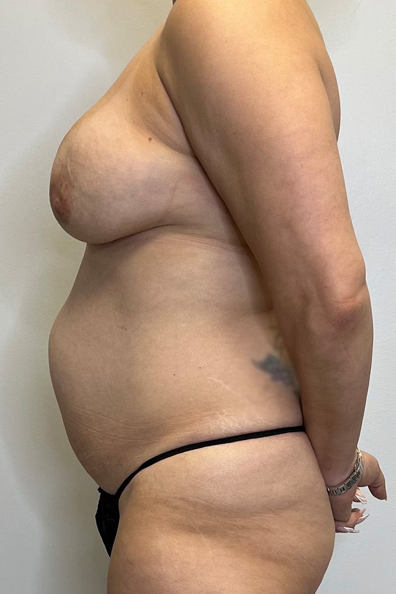 Tummy Tuck Before & After Gallery - Patient 143665 - Image 9