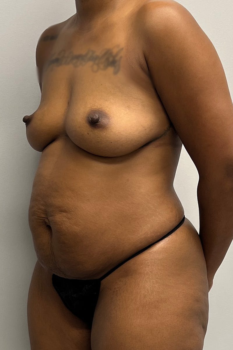 Tummy Tuck Before & After Gallery - Patient 330160 - Image 5