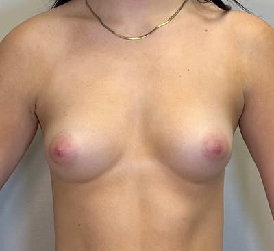 Breast Augmentation Before & After Gallery - Patient 343965 - Image 1