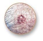 Close-up image of a basal cell carcinoma skin cancer