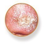 Close-up image of a squamous cell carcinoma skin cancer