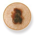 Close-up image of a melanoma skin cancer growth