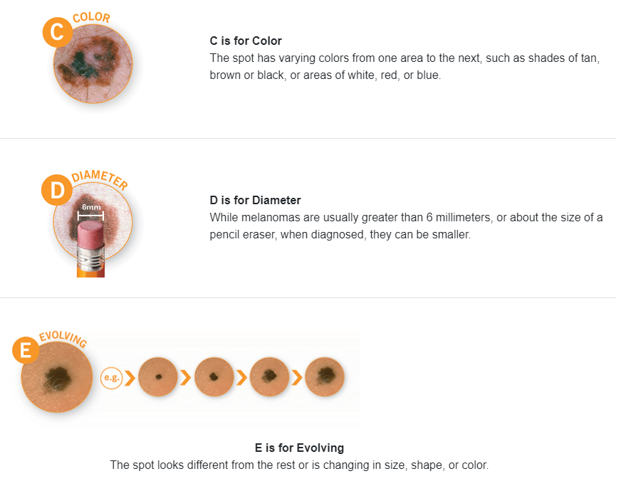 Cs and Ds of Skin Cancer