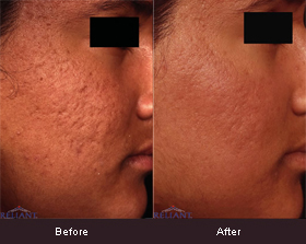 Acne scarring treatment before and after