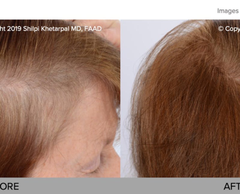 PRP hair restoration results
