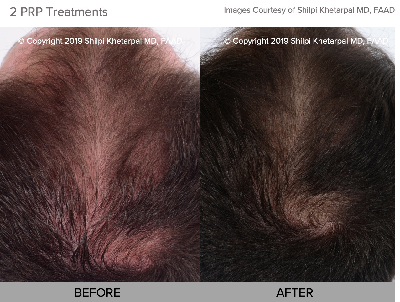 PRP hair restoration before and afters