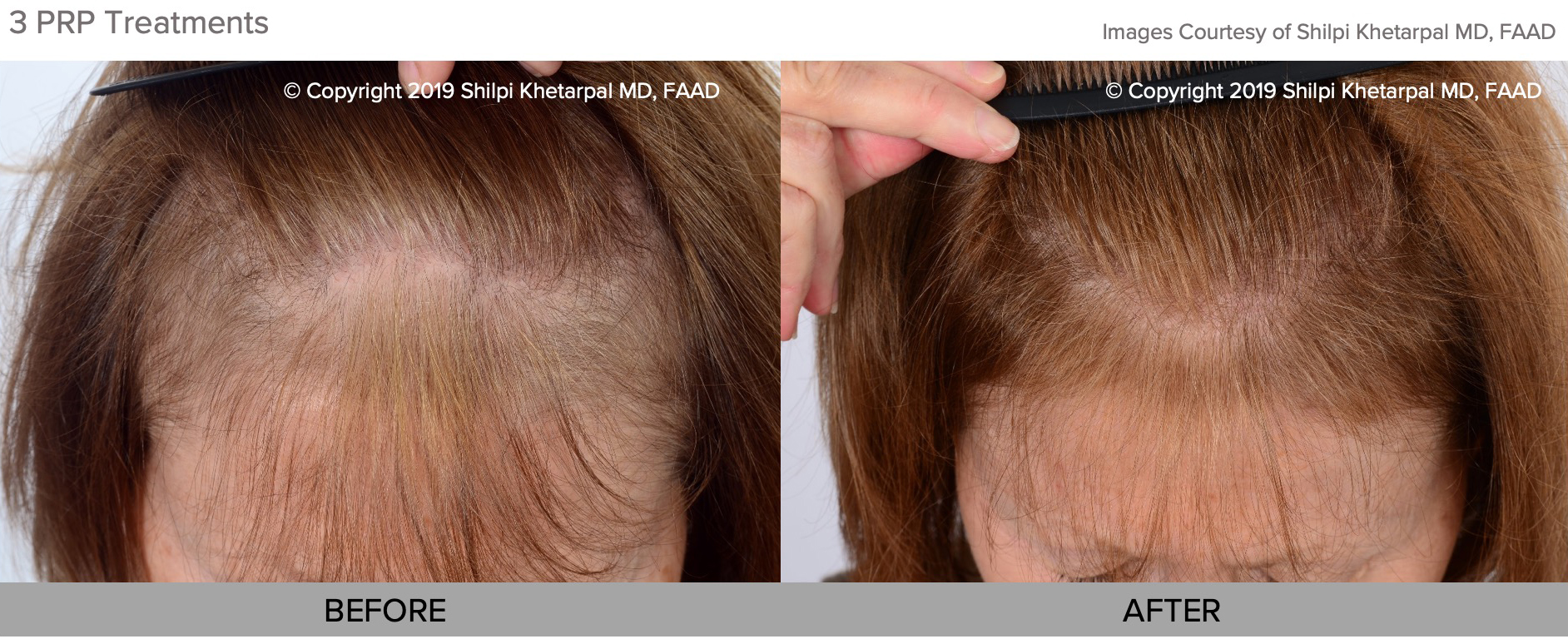 PRP hair restoration before and afters 2