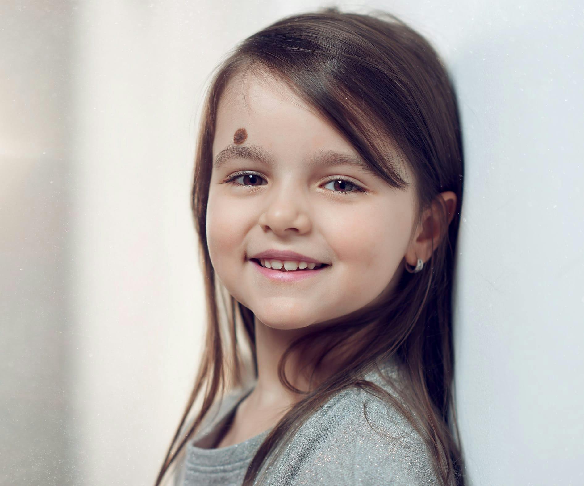 Birthmark Around Eye