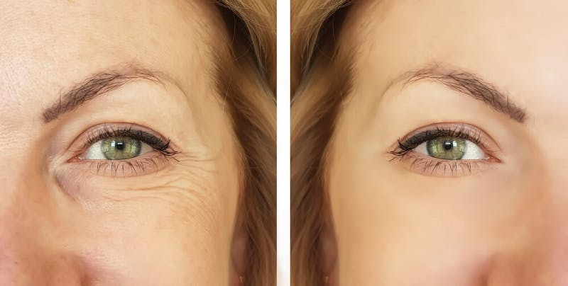 A before & after of a woman's eye area