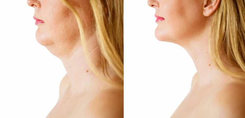 Facelift B&A