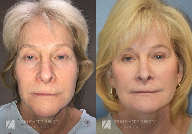 Facelift Before & After Gallery - Patient 106400524 - Image 1