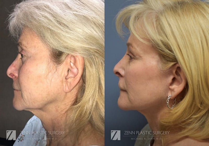 Facelift Before & After Gallery - Patient 106400524 - Image 2