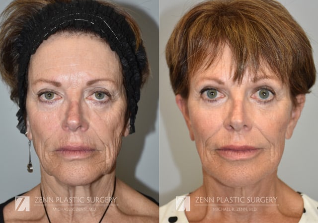 Patient 106400525 | Facelift Before & After Photos | Zenn Plastic