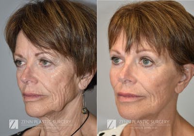 Facelift Before & After Gallery - Patient 106400525 - Image 2