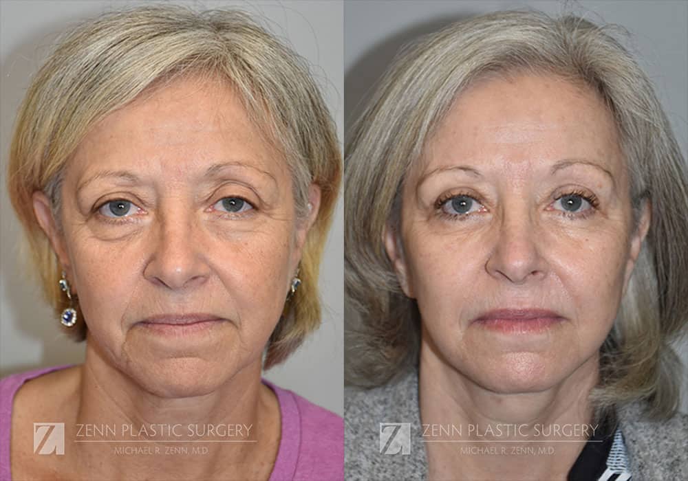 Patient 106400526 | Facelift Before & After Photos | Zenn Plastic