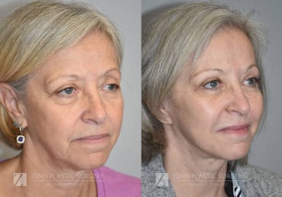 Facelift Before & After Gallery - Patient 106400526 - Image 2