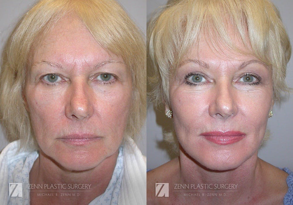 Facelift Before & After Gallery - Patient 106400527 - Image 1