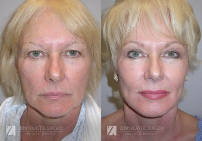 Facelift Before & After Gallery - Patient 106400527 - Image 1
