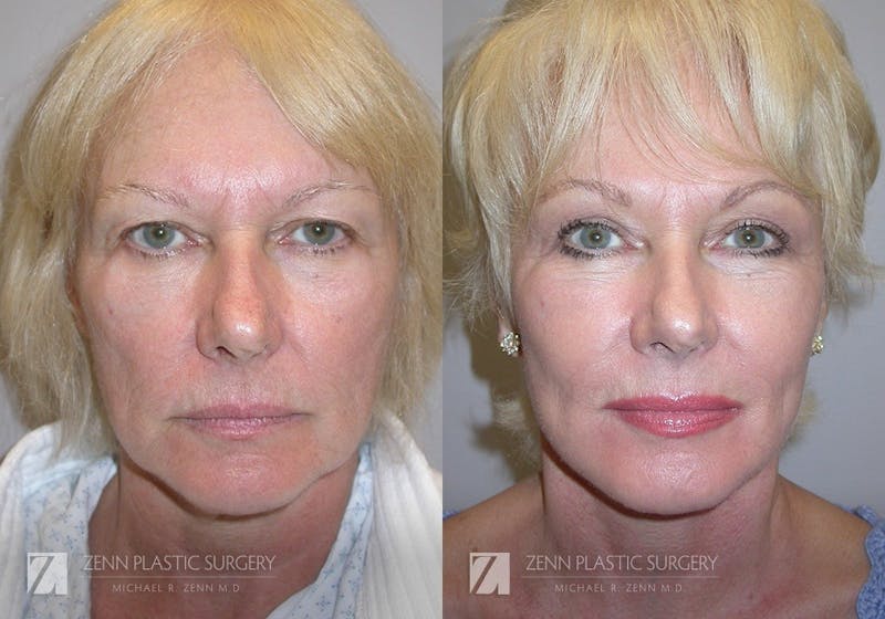 Facelift Before & After Gallery - Patient 106400527 - Image 1