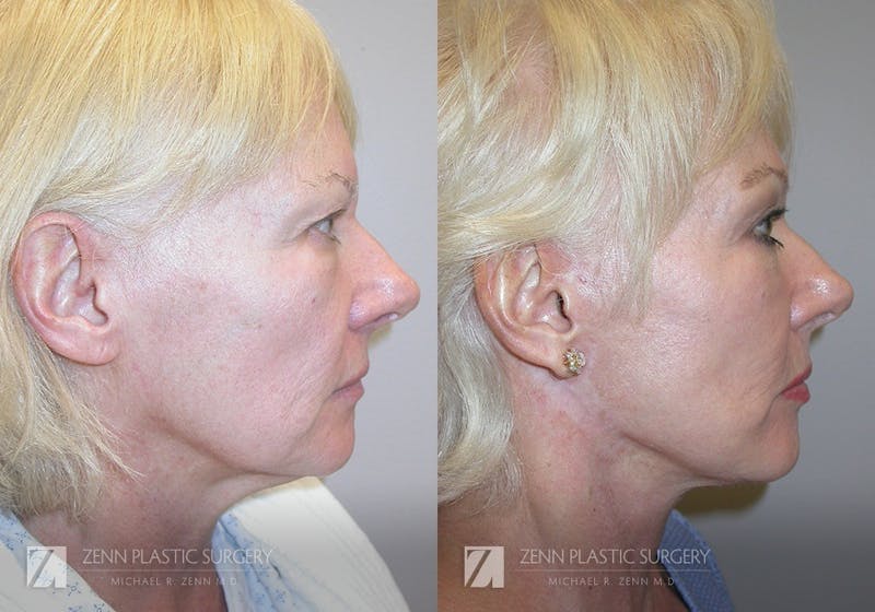 Facelift Before & After Gallery - Patient 106400527 - Image 2