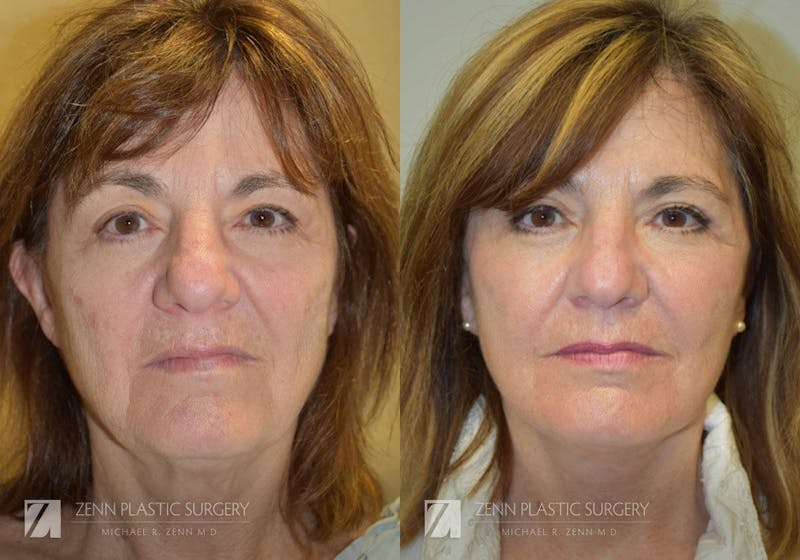 Facelift Before & After Gallery - Patient 106400529 - Image 1