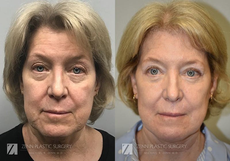 Facelift Before & After Gallery - Patient 106400530 - Image 1