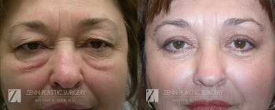 Blepharoplasty / Browlift Before & After Gallery - Patient 106400531 - Image 1