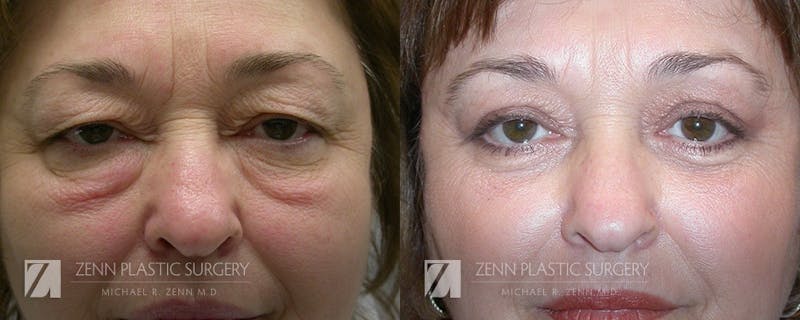Blepharoplasty / Browlift Before & After Gallery - Patient 106400531 - Image 1