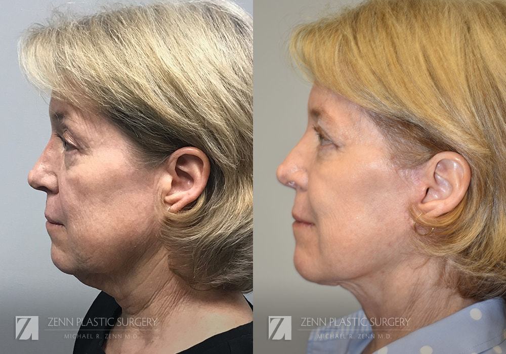 Patient 106400530 | Facelift Before & After Photos | Zenn Plastic