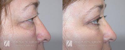 Blepharoplasty / Browlift Before & After Gallery - Patient 106400531 - Image 2