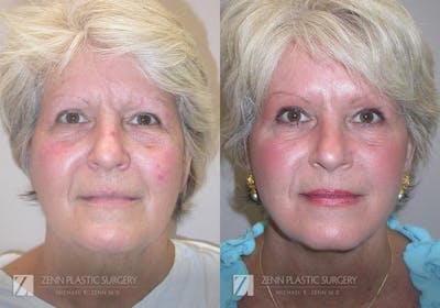 Facelift Before & After Gallery - Patient 106400532 - Image 1