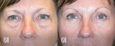 Blepharoplasty / Browlift Before & After Gallery - Patient 106400533 - Image 1