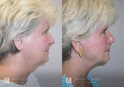 Facelift Before & After Gallery - Patient 106400532 - Image 2