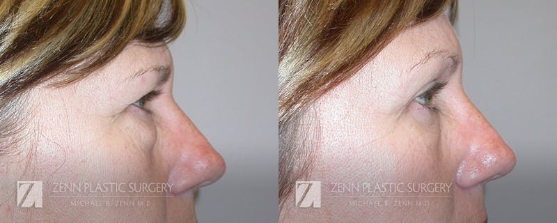 Blepharoplasty / Browlift Before & After Gallery - Patient 106400533 - Image 2