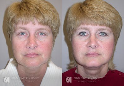 Facelift Before & After Gallery - Patient 106400536 - Image 1