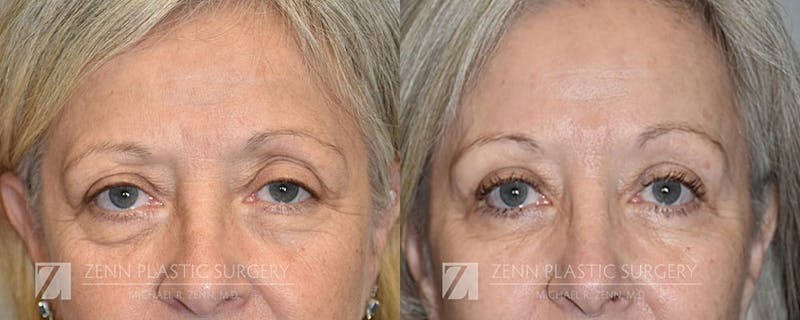 Blepharoplasty / Browlift Before & After Gallery - Patient 106400535 - Image 1