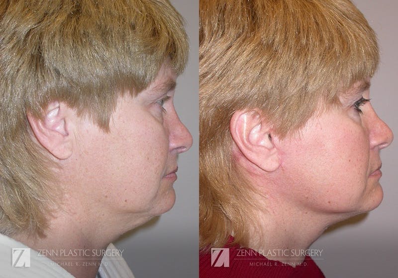 Facelift Before & After Gallery - Patient 106400536 - Image 2