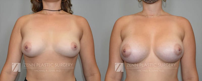 Breast Augmentation Before & After Gallery - Patient 106400540 - Image 1