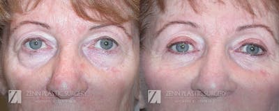 Blepharoplasty / Browlift Before & After Gallery - Patient 106400538 - Image 1