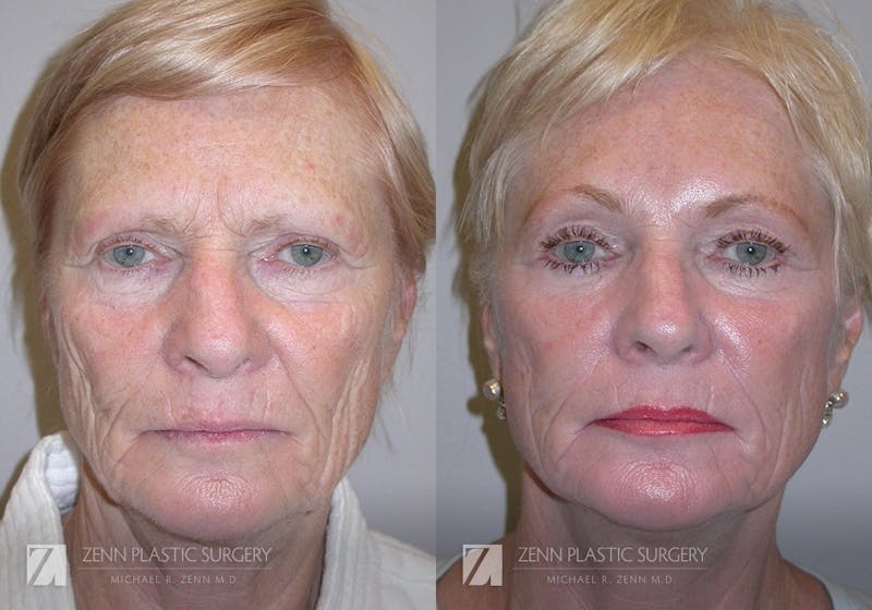 Facelift Before & After Gallery - Patient 106400539 - Image 1