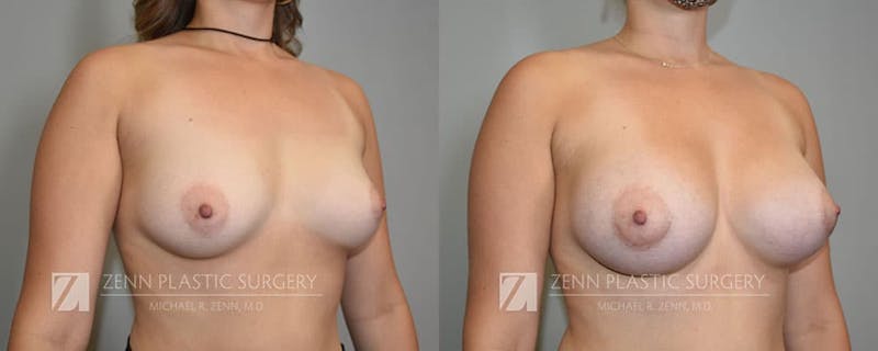 Breast Augmentation Before & After Gallery - Patient 106400540 - Image 2