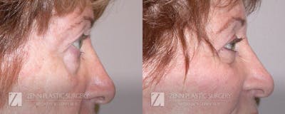 Blepharoplasty / Browlift Before & After Gallery - Patient 106400538 - Image 2